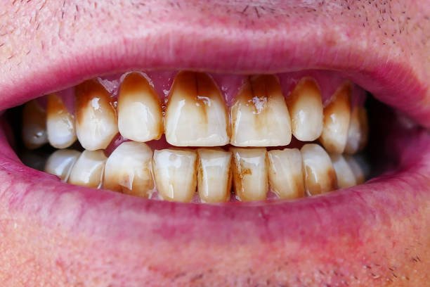 Impact of cigarette smoke on oral health - how we should stop the harmful consequences of high-temperatures burning tobacco?