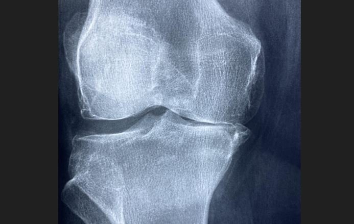 Njemački naučnici razvili gel koji može obnoviti zglobove bez operacije i implantata