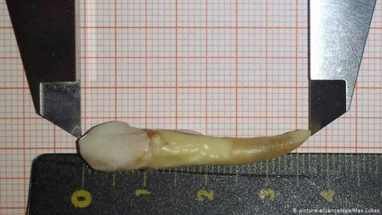 Ginisov rekord: Njemac izvadio zub od 37,2 milimetra