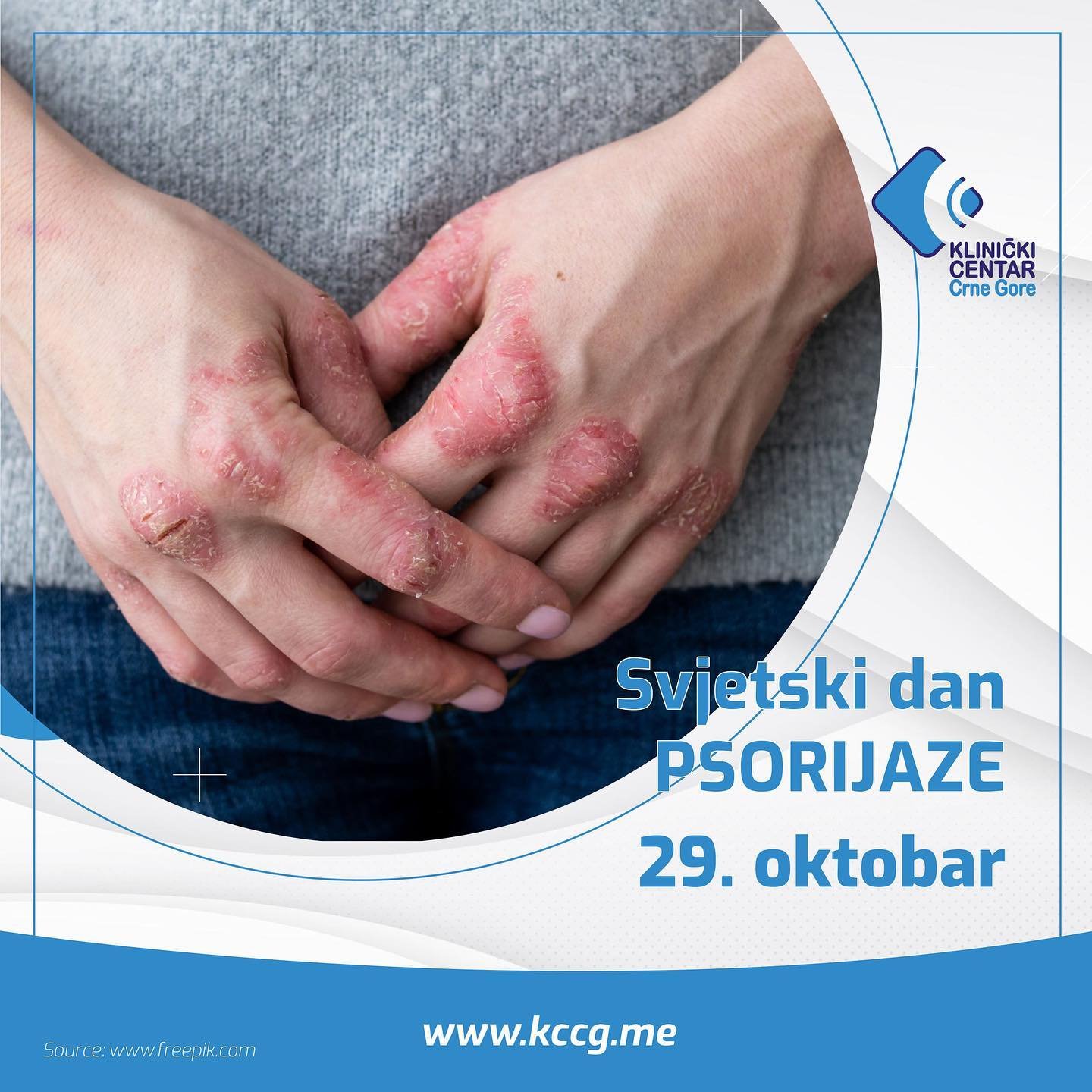 Međunarodni dan borbe protiv psorijaze: “Dan otvorenih vrata” na Klinici za dermatovenerologiju