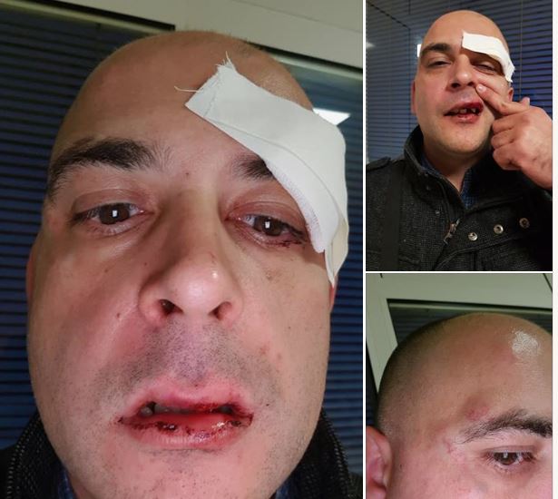 Beograd: Brutalno ga pretukli zbog ljubičaste torbice za psa