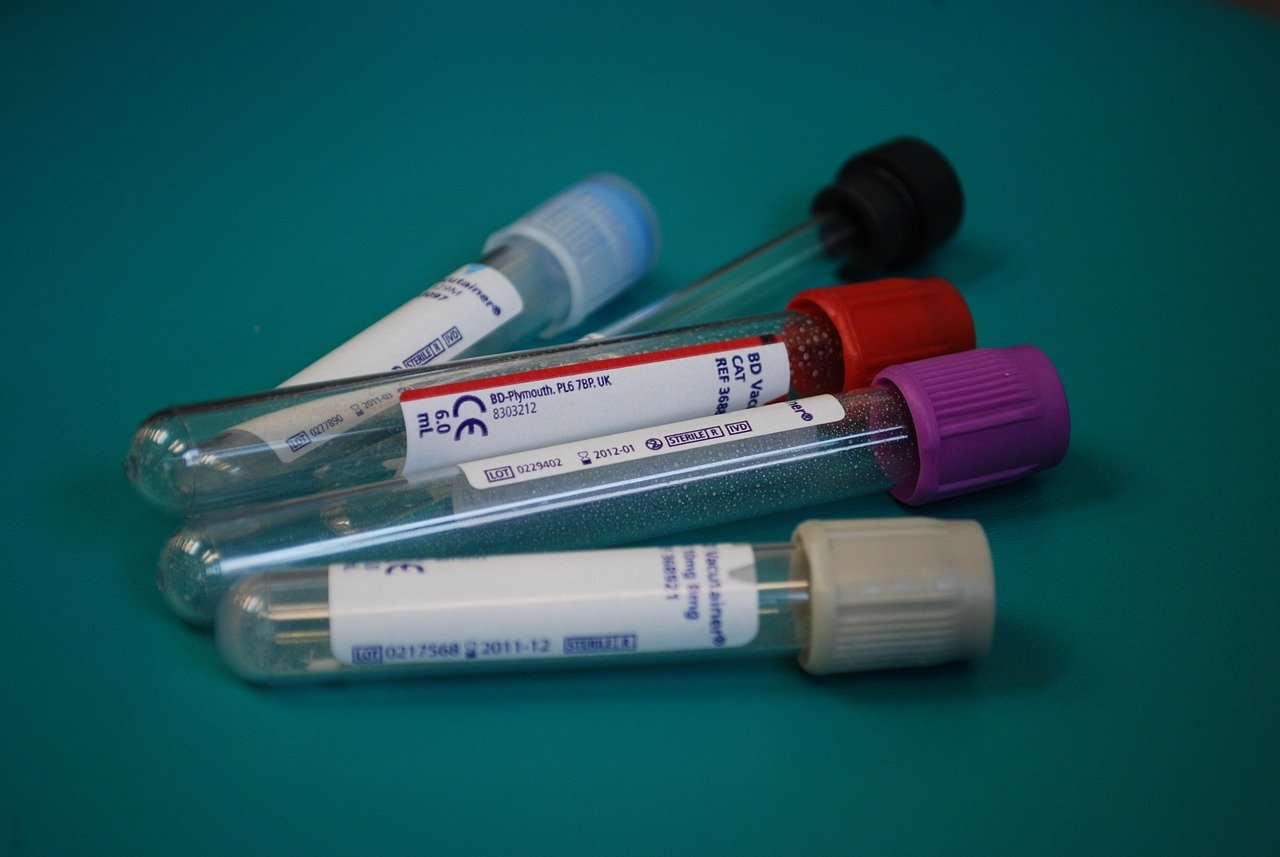 Test krvi mogao bi da identifikuje milione ljudi koji nesvesno šire tuberkulozu