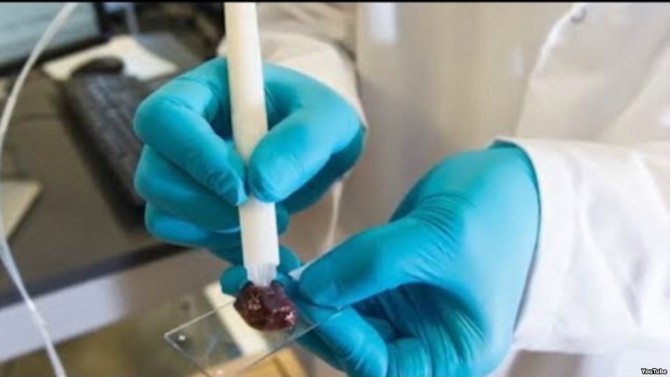 "Olovka" koja otkriva tumor za samo 10 sekundi