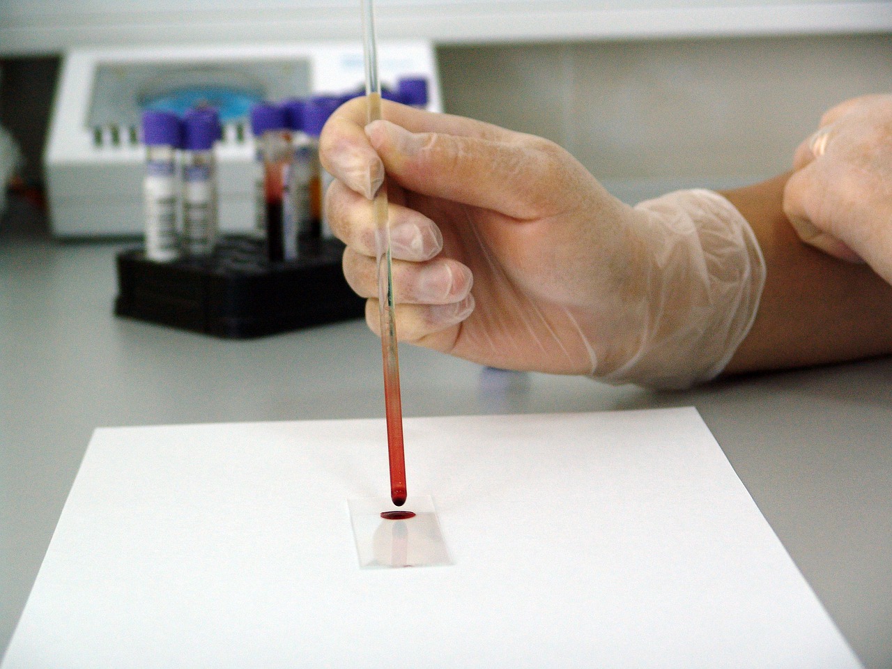 Šta vam sve govori analiza krvne slike i kako da je čitate